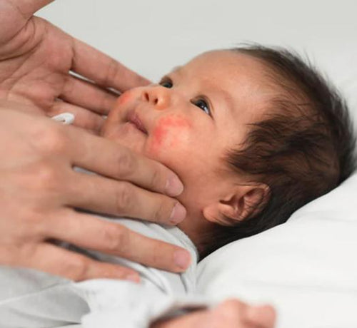 KOŽA SKLONA EKCEMU: KAKO RAZGOVARATI O TOME U VRTIĆU/ŠKOLI - Mustela Multi-market - 1