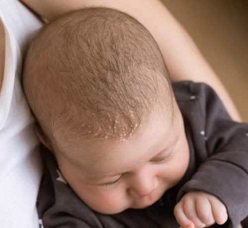 Tout savoir sur les croûtes de lait - Mustela Multi-market - 1
